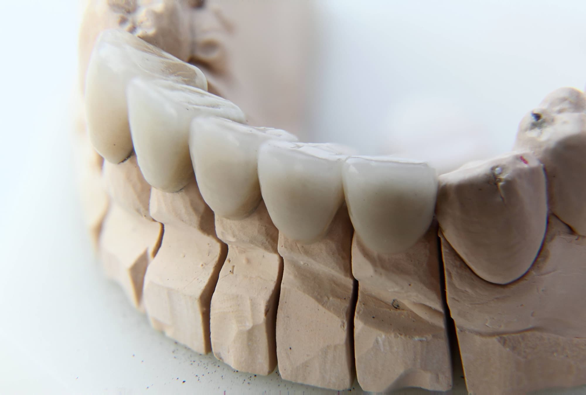 A ceramic-veneered dental crown photographed in close focus-stacked detail against a neutral background.