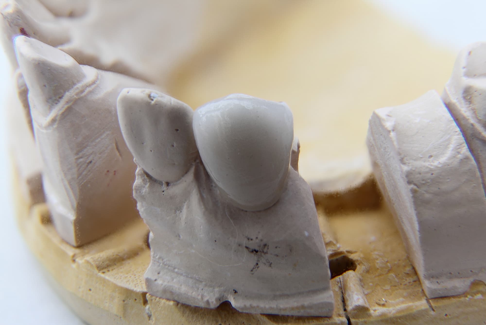 Close detail of a dental crown showing translucency through the incisal edge under directional lighting.